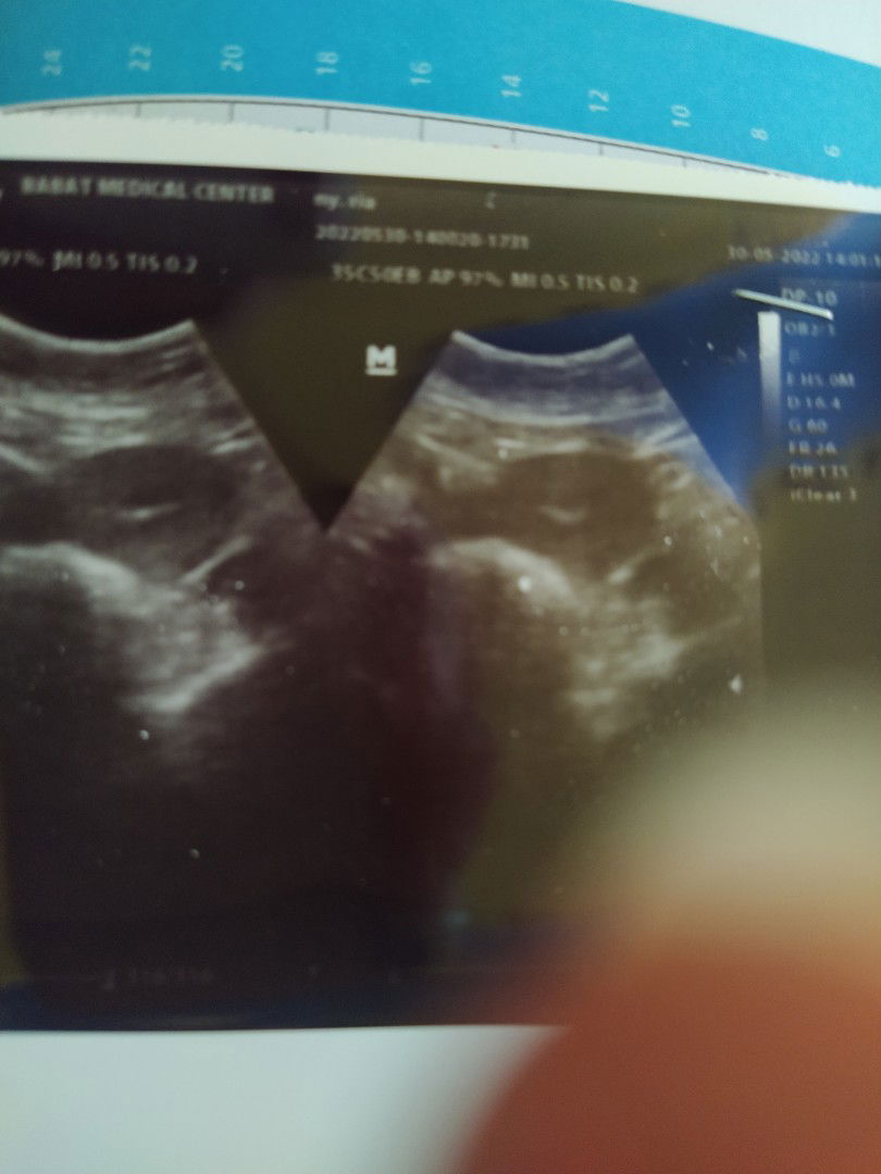 Usg 7minggu masi kelihatan kantongnya aja,trus ngeflek juga,bahaya gk bun
