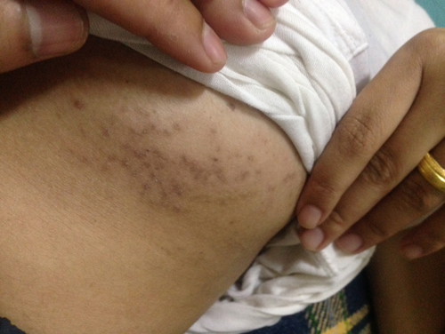 ผื่นคัน