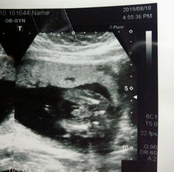 18 w 6 d