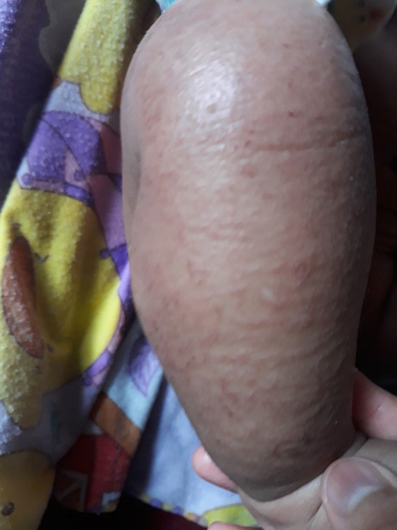 dermatitis atopik