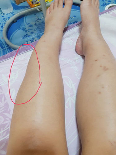 ขาบวม