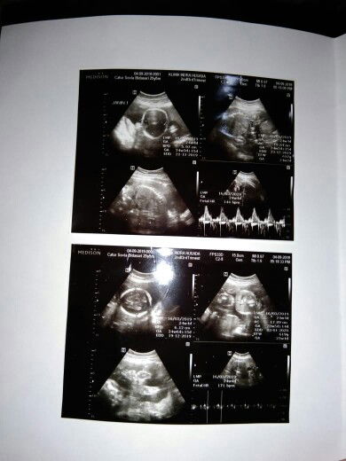 janin gemeli / kembar