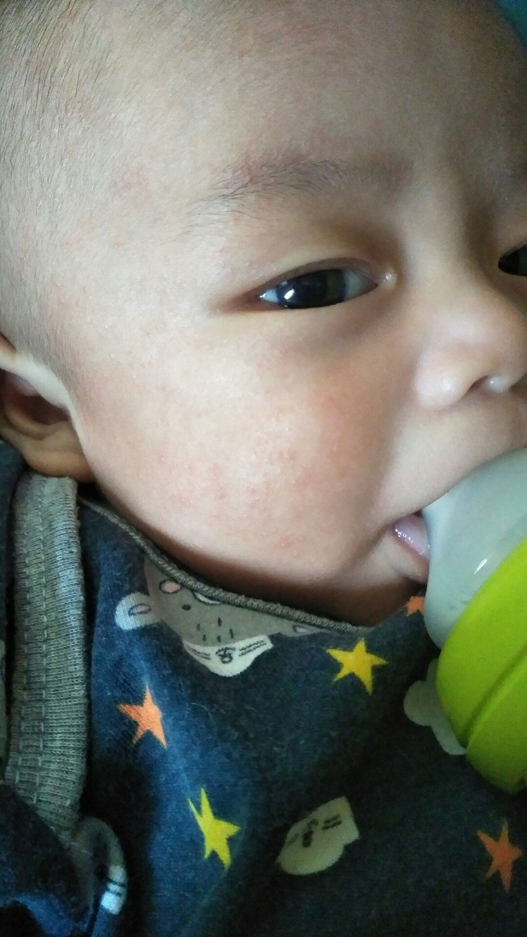 ruam pipi/dan kulit kering