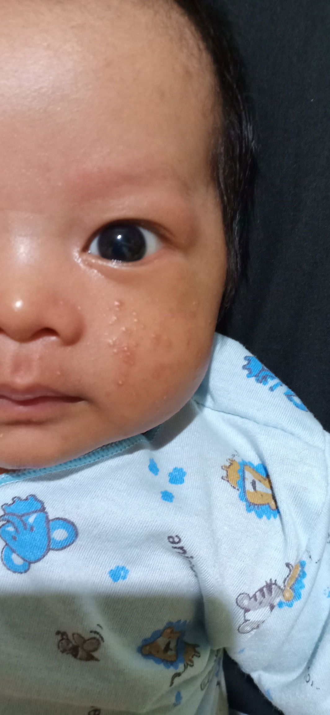 Bintik bintik seperti biang keringat di pipi