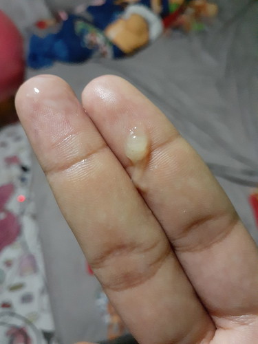 ตั้งครรภ์35w4d