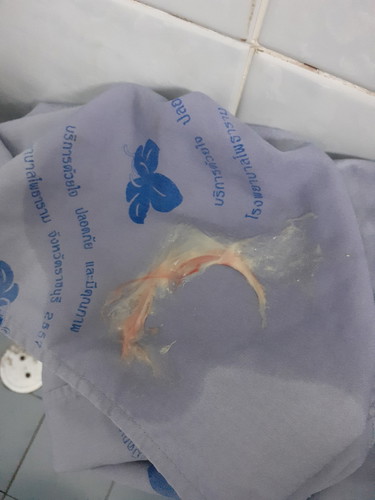 ปากมดลูกเปิด2เซน?