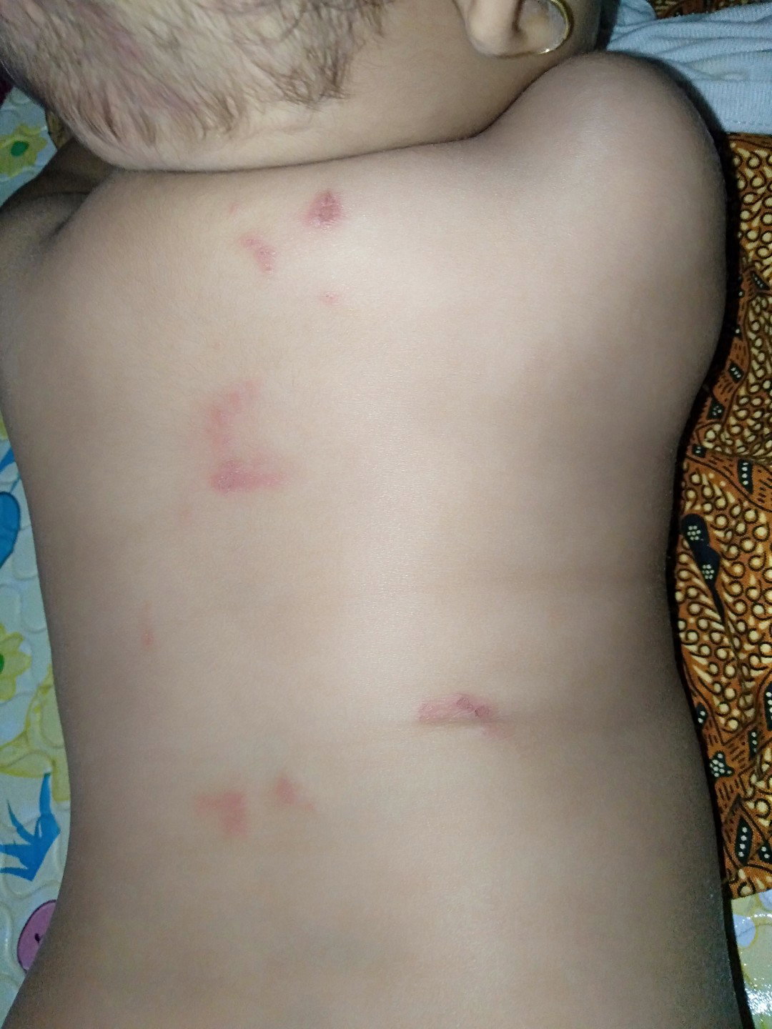 kulit bayi merah2