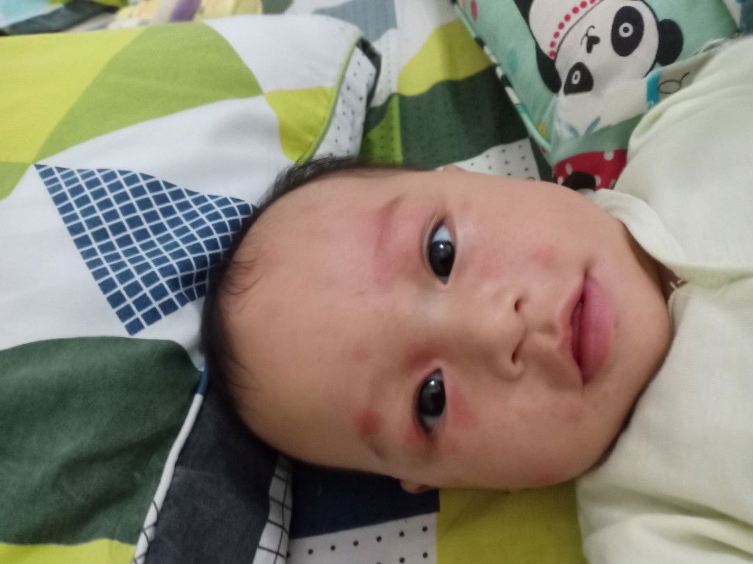 muka bruntusan merah