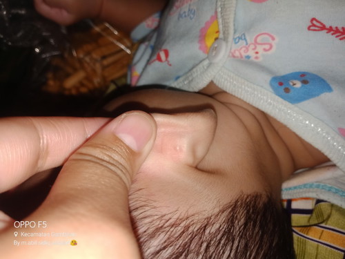 bintik d telingga