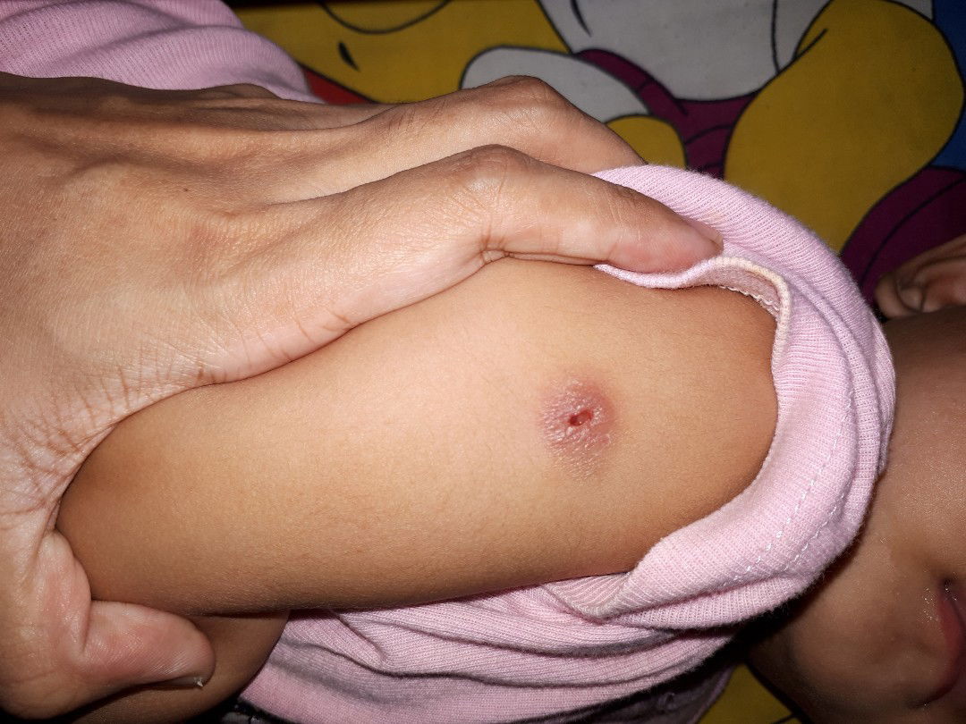 Luka bekas vaksin BCG