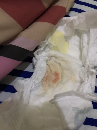 Kencing Bayi umur 4hr ada noda darah