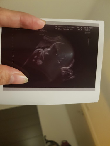 ลักษณะเด็กหัวโต