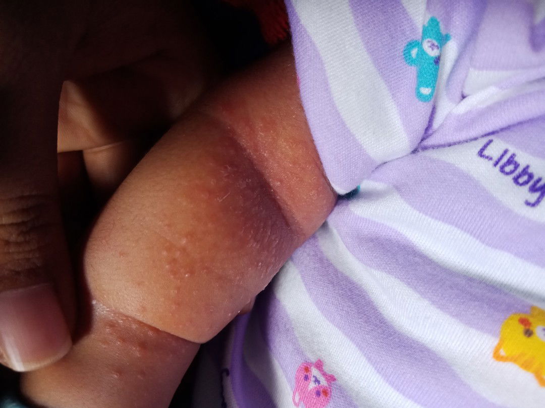 Bintik merah/keringet buntet