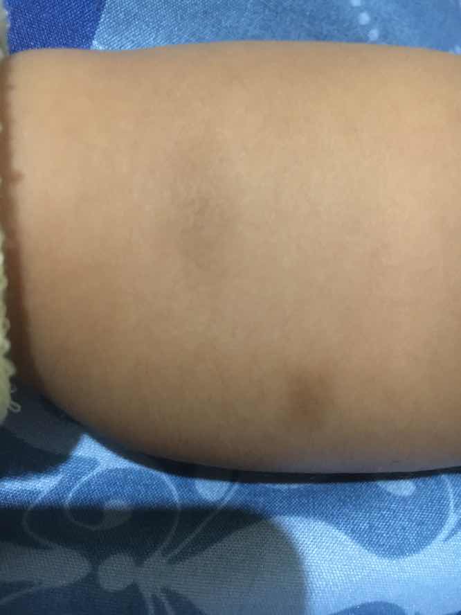 Penghilang bekas gigitan nyamuk