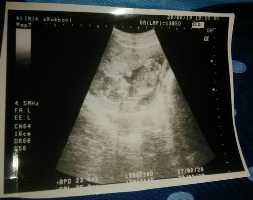 cara melihat berat dan uk panjang janin di hasil usg