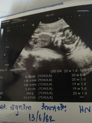 20w1d แร้วค่ะ?