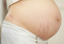 stretch mark