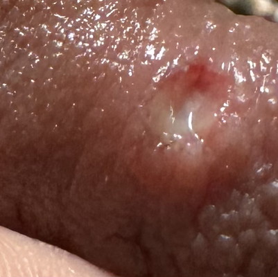 Luka bahagian puting