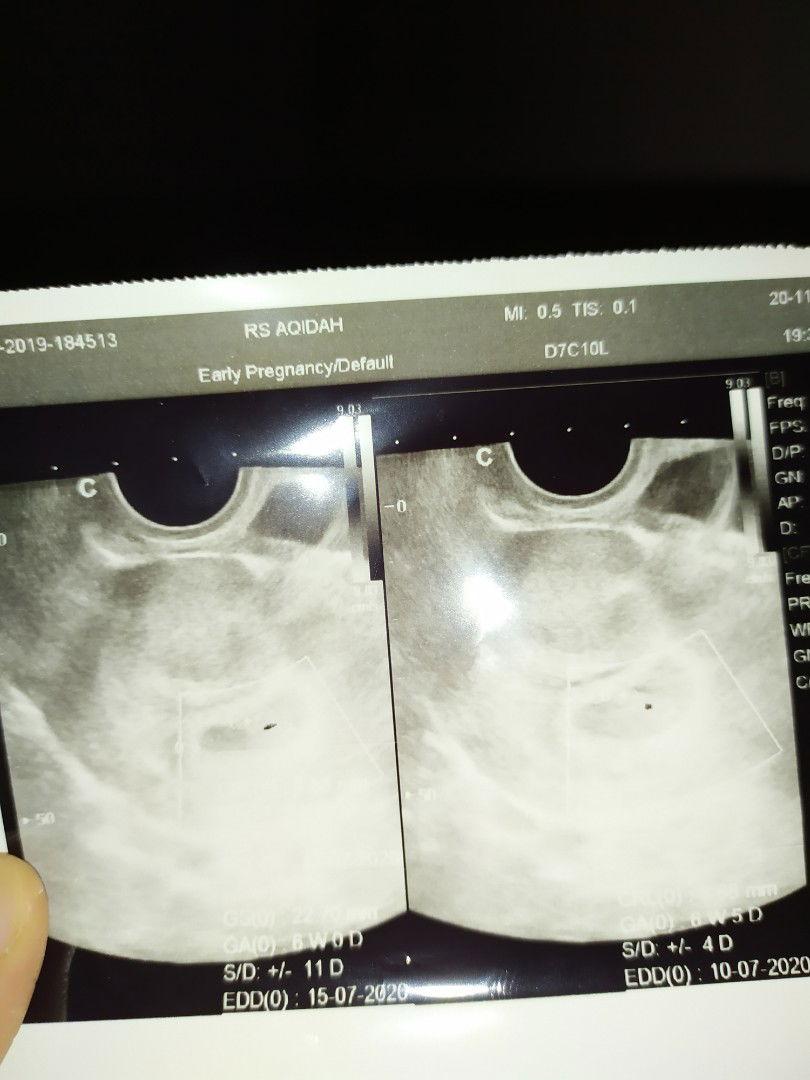 Ketuban keruh dan Infeksi kuman