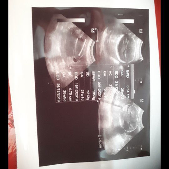 Hasil usg 2 dimensi kandungan 26 minggu