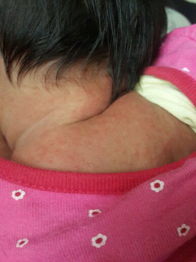 obat bruntusan merah kecil untuk bayi