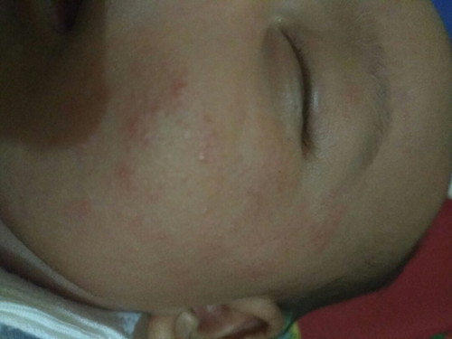 Merah pipi bayi