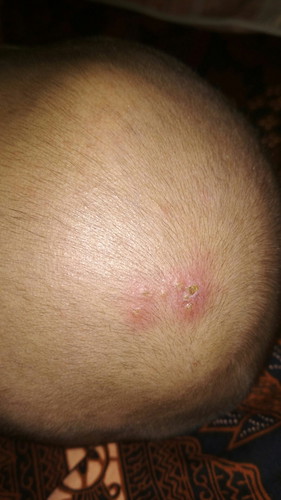 kepala kayak berjerawat