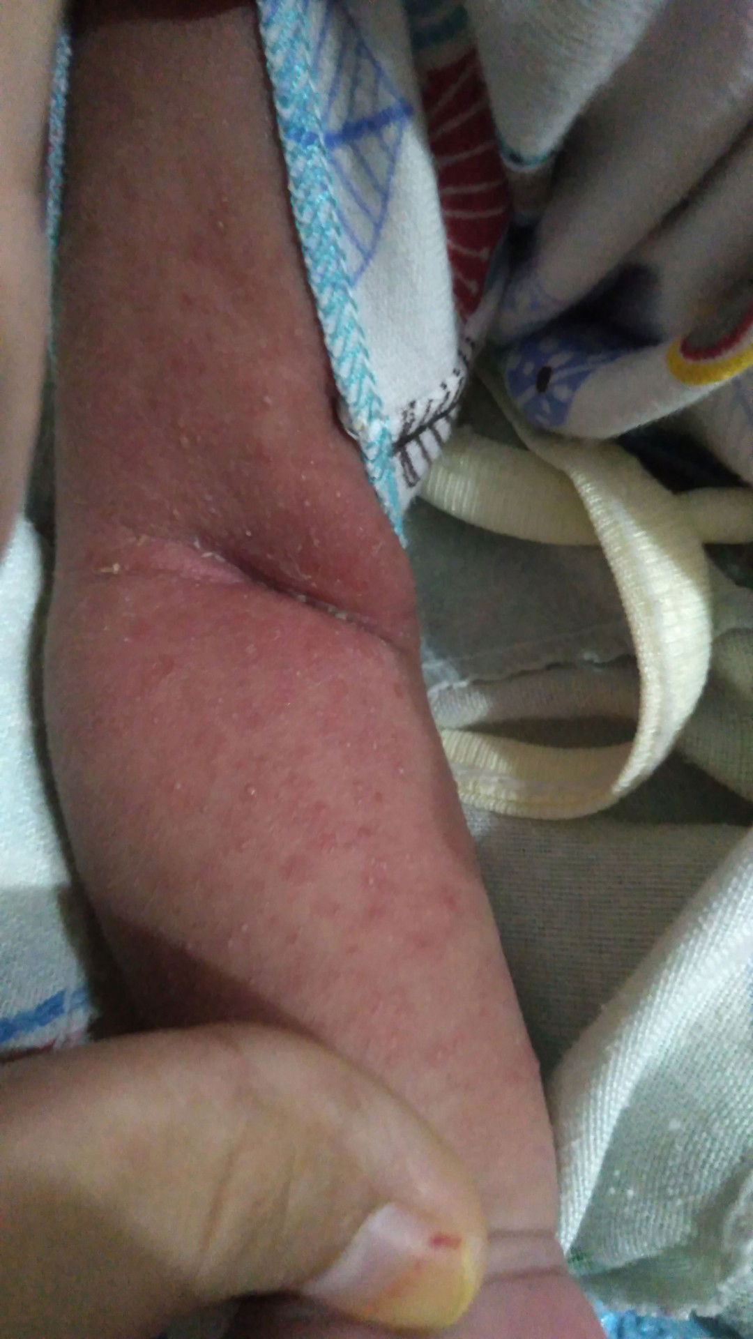 bintik merah dan kadang ad yg bernanah juga