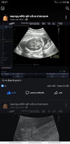 เด็กขนาดต่ำกว่าเกณฑ์ นิดนึง