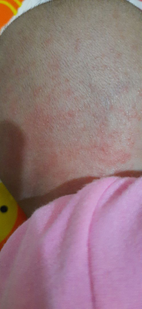 cara menghilangkan biang keringat pada bayi