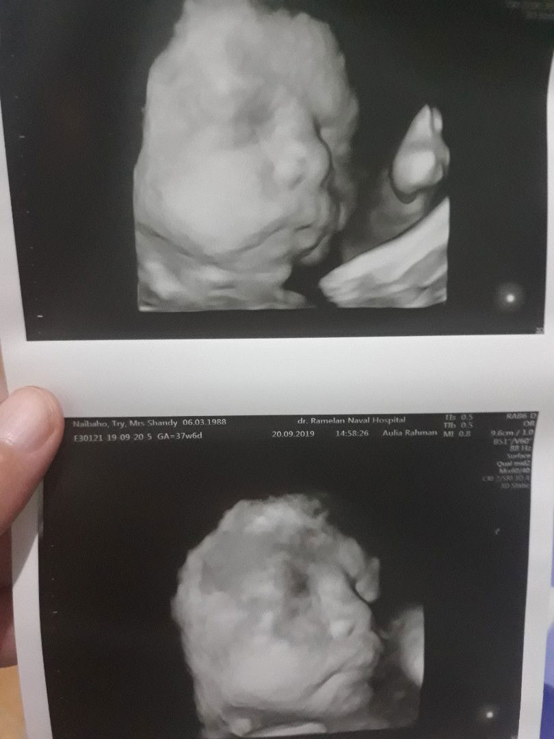 akhirnya baby ku memutarkan kepalanya