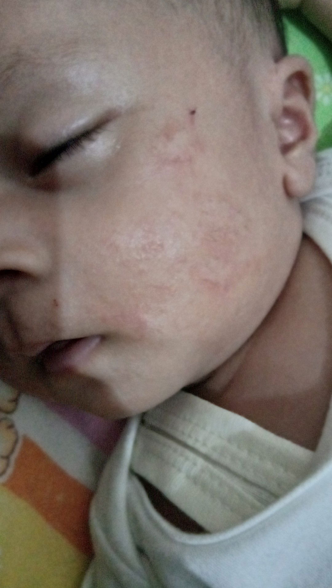 Muka merah bruntusan