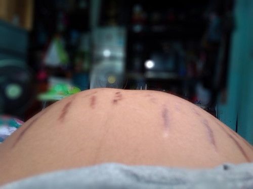 ท้องแตก