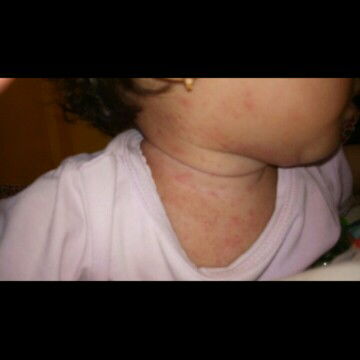 bintik merah,biang keringat kah?