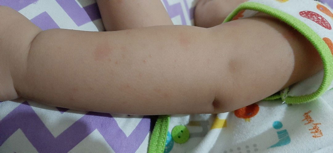 timbul bintik merah ditangan aja.