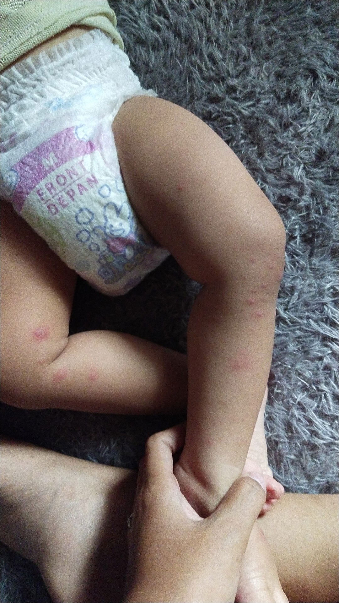 kulit bayi ruam merah seperti cacar