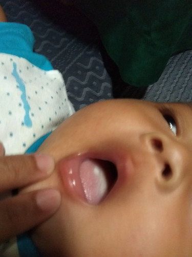 lidah bayi putih