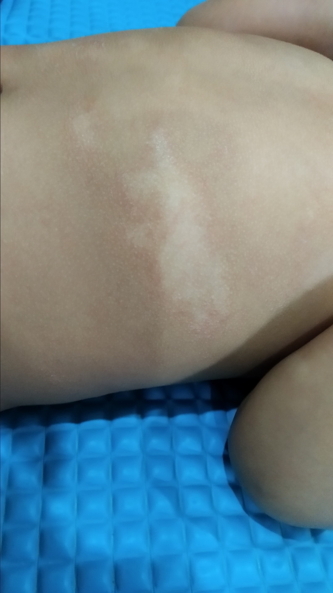 Kulit bayi bercak putih