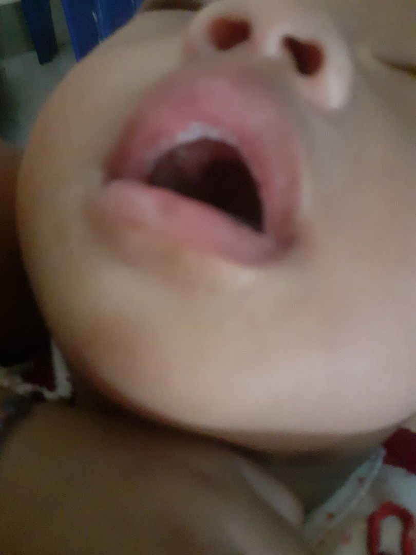 guam mulut bayi