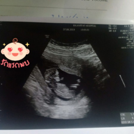 เเบบนี้ อายุครรภ์ดูประมาณกี่สีคะ