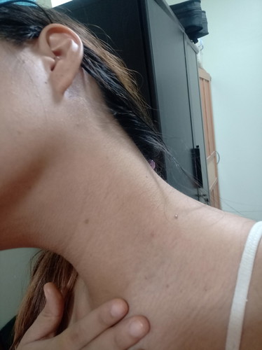 สิว หรือรอยดำขึ้นบริเวณคอ