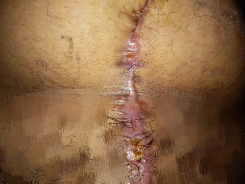 Cs Wounds