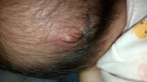 red bumps on may babies head