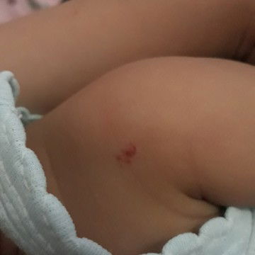 bercak darah dikulit bayi