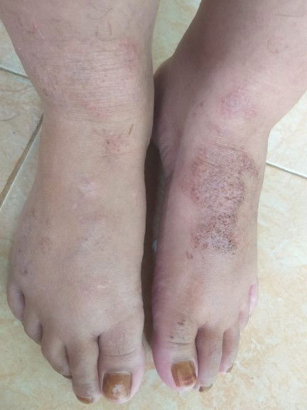 Kaki gatal saat hamil