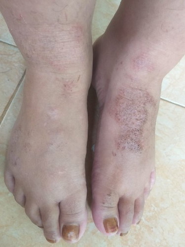 Kaki gatal saat hamil