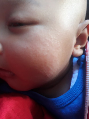 ruam pipi