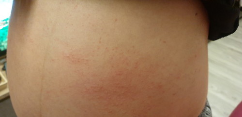 Red rash on bump