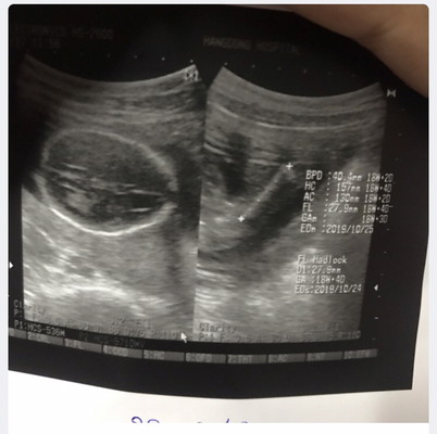 สอบถามเรื่อภาพอุลตร้าซาวด์หน่อยค่ะ