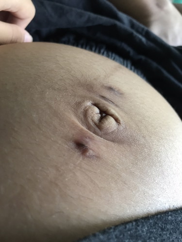 มีแม่ๆคนไหนเจาะสะดือบ้างคะ